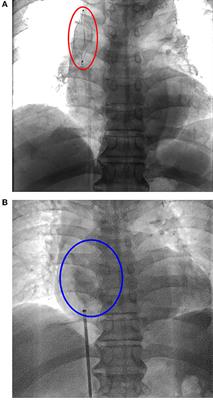 Case Report: Pericardial Tamponade and Hemothorax After Superior Vena Cava Filter Removal